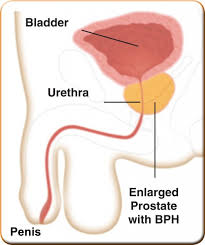 Prostate-Treatment