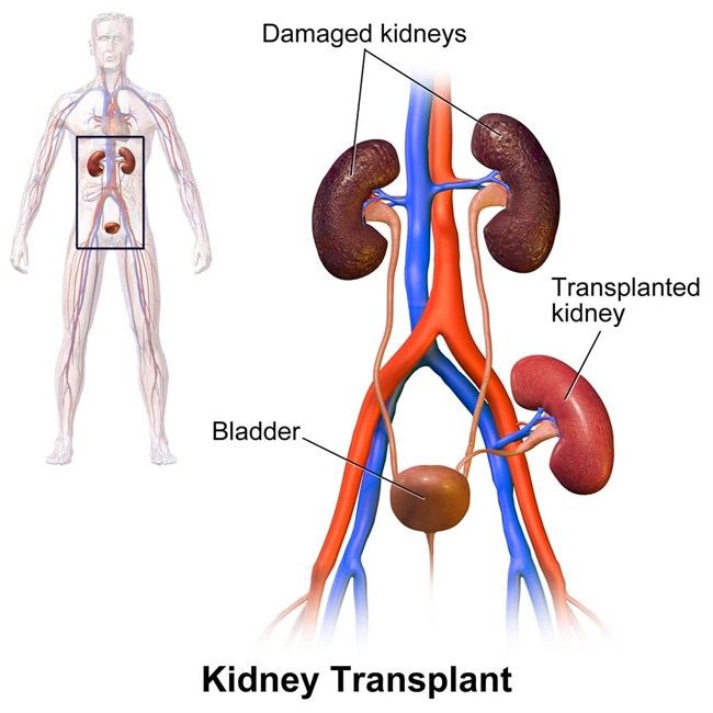 Kidney-Stone