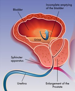 Prostate-Enlargement