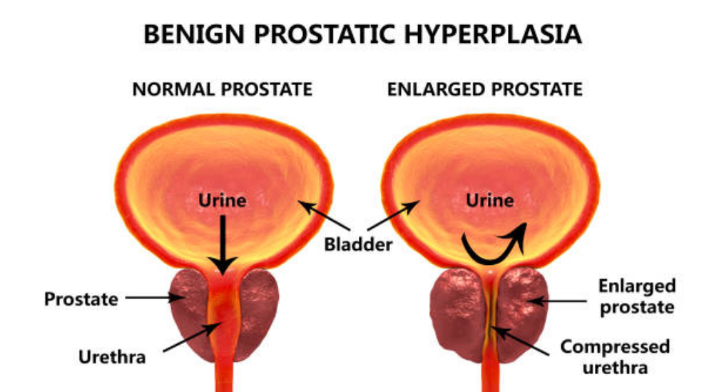 Enlarged-prostate