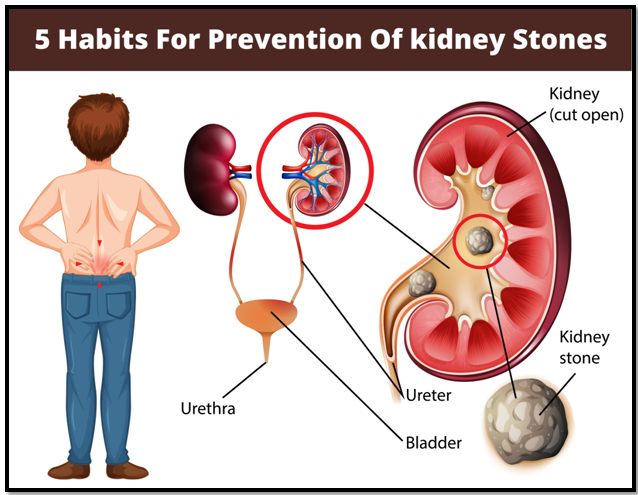 Kidney stone specialist in Pune
