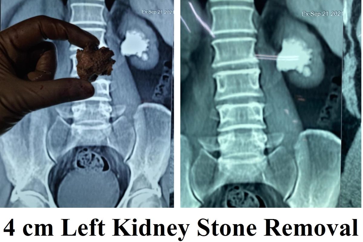 Kidney Stone Removal