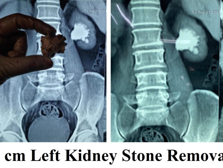 Kidney Stone Removal