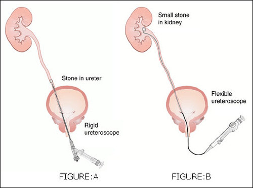 24-500x500-1 Ureteroscopy