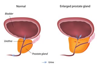 Enlarged-Prostate-Symptoms-and-Signs