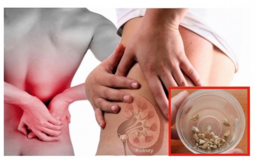 Kidney-stone-treatment-in-pune Kidney-Stone-Treatment