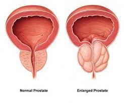 What-Is-an-Enlarged-Prostate?