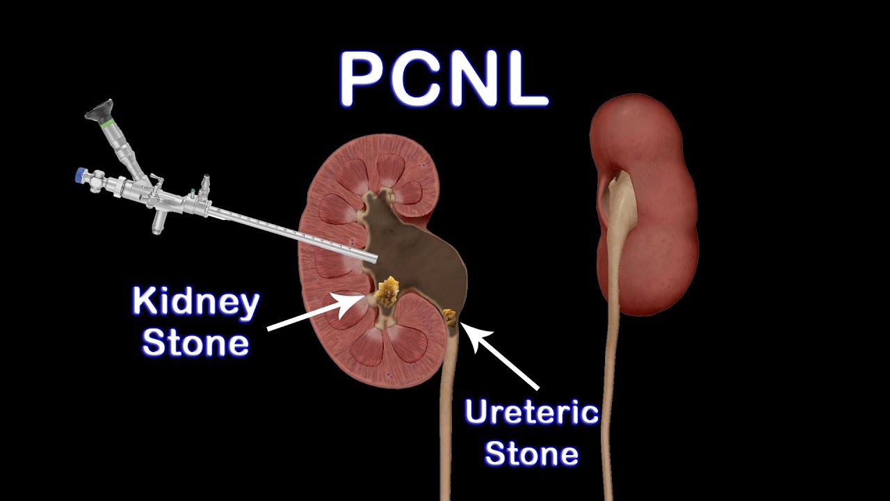 PCNL (percutaneous nephrolithotomy or stone extraction)