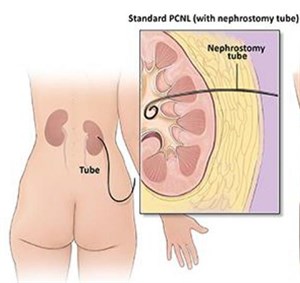 pcnl percutaneous-nephrolithotomy-or-stone-extraction