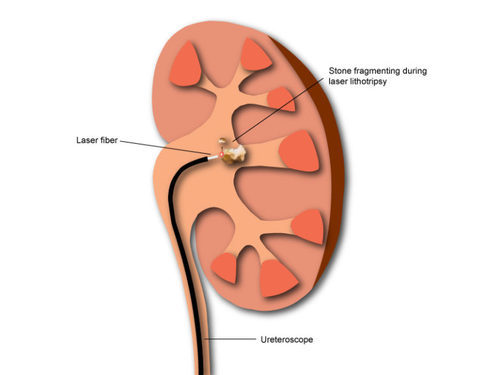 Retrograde-Intrarenal-Surgery