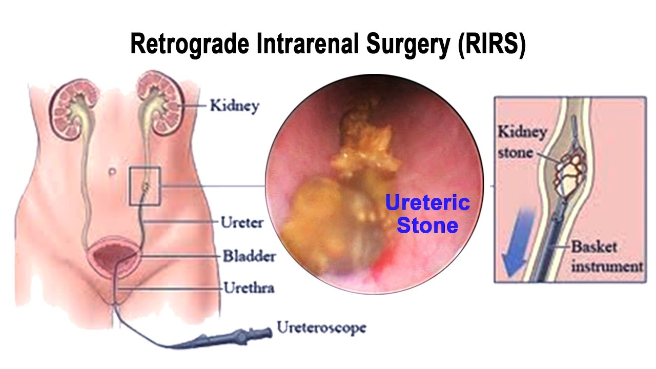 Retrograde-Intrarenal-Surgery