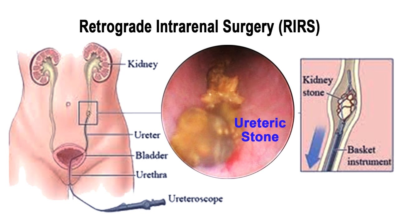 rirs Retrograde-Intrarenal-Surgery
