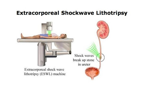 unnamed ESWL-Lithotripsy