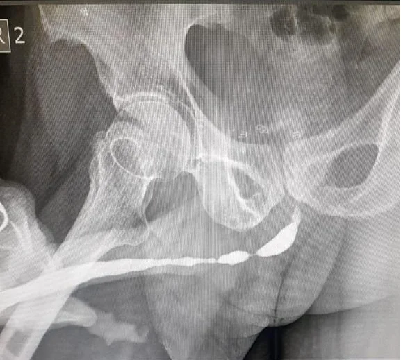 Stricture-Urethra
